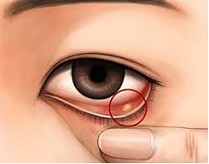 大阪弁 めばちこ